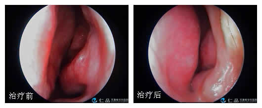 鼻甲肥大不治,谨防哮喘等并发症